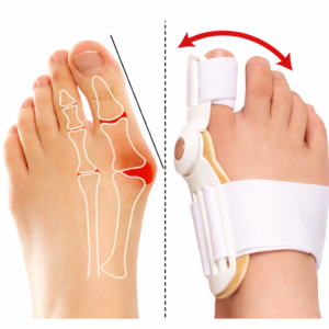 مصحح إبهام القدم الطبي لتعديل اعوجاج Hallux Valgus مع توضيح تصحيح زاوية الإبهام وتخفيف الضغط على المفصل